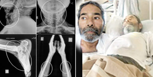 man with many pins inside his body becomes mystery for doctors
