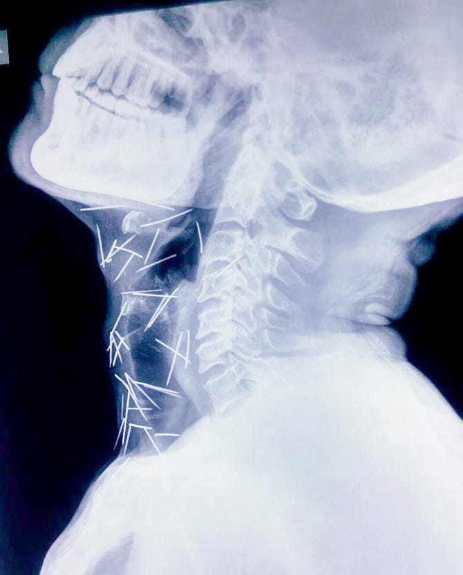 man having 75 pins got inside his body