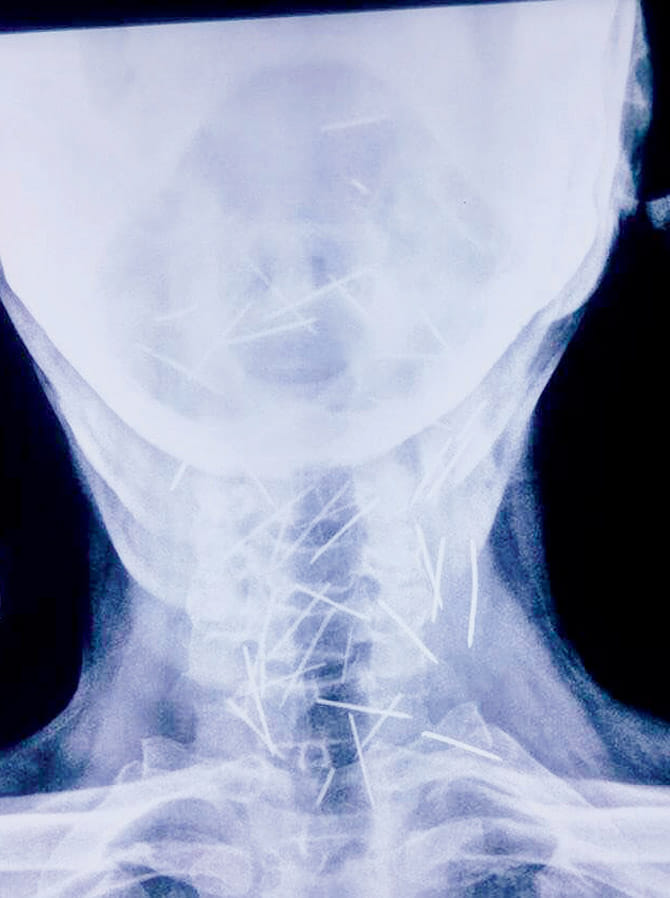 man having 75 pins got inside his body