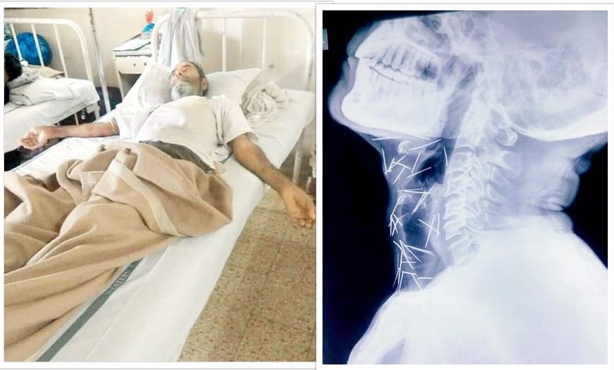 man having 75 pins got inside his body