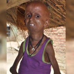  Yogi Sarkar came forward to help this person suffering from 'Amitabh' Progeria disease