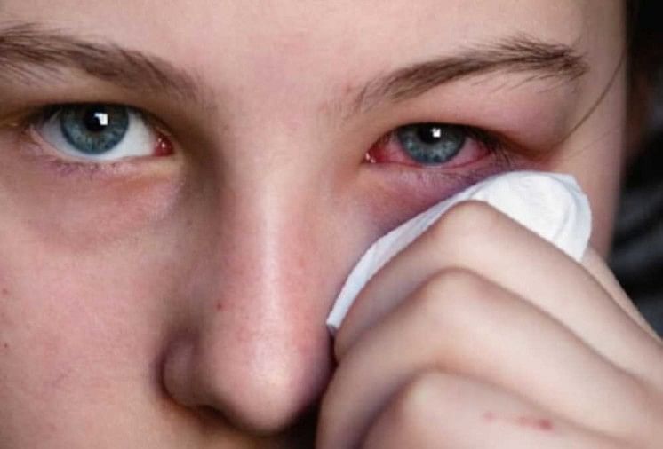 conjunctivitis-eye-flu-in-delhi