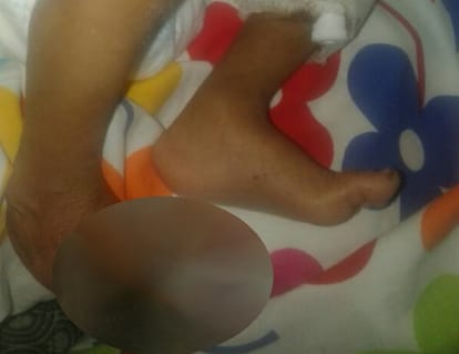 child died from gangrene in rajkiya bal griha shishu in lucknow