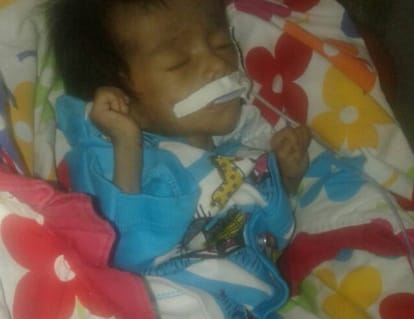 child died from gangrene in rajkiya bal griha shishu in lucknow