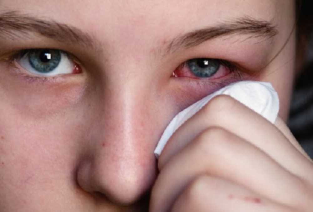 uttarakhand news: Rain and changing weather is increasing eye pain, keep these things in mind
