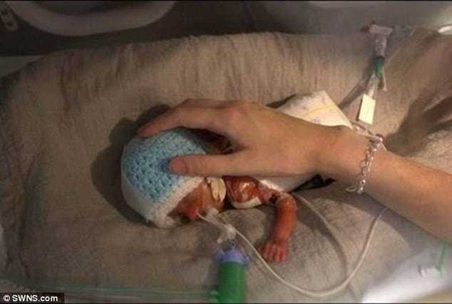 baby born at just 23 weeks with black toe 