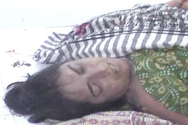 Acid attack victim's death in bhilwara
