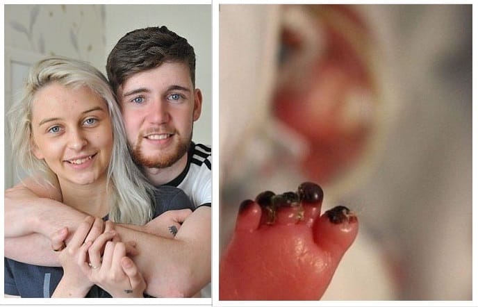 baby born at just 23 weeks with black toe 