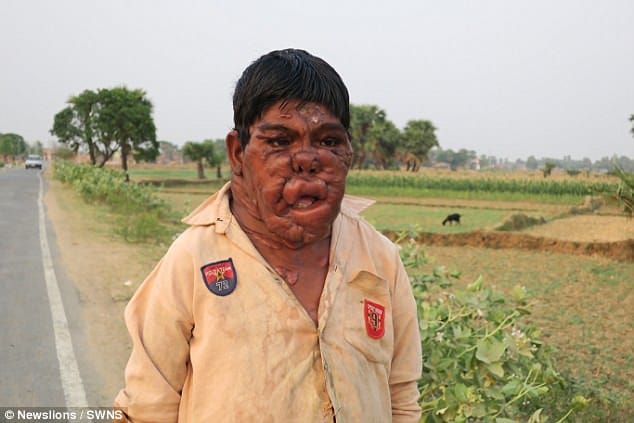 Indian ghost boy mithun chauhan is suffering from tumors