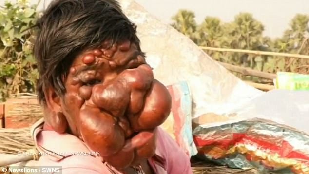 Indian ghost boy mithun chauhan is suffering from tumors