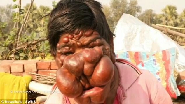 Indian ghost boy mithun chauhan is suffering from tumors