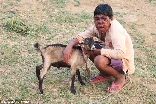 Indian ghost boy mithun chauhan is suffering from tumors