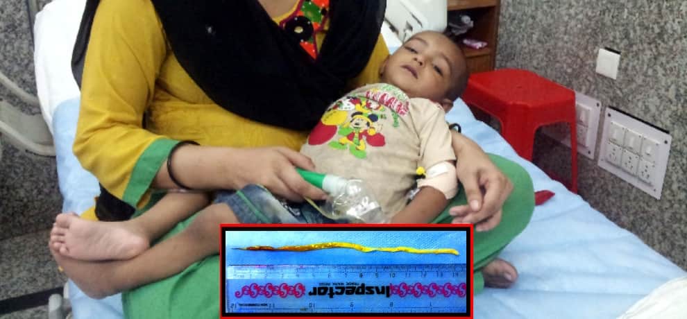 doctors of gb pant hospital operated a child lever having 6 inch worm by indoscpe Technic 