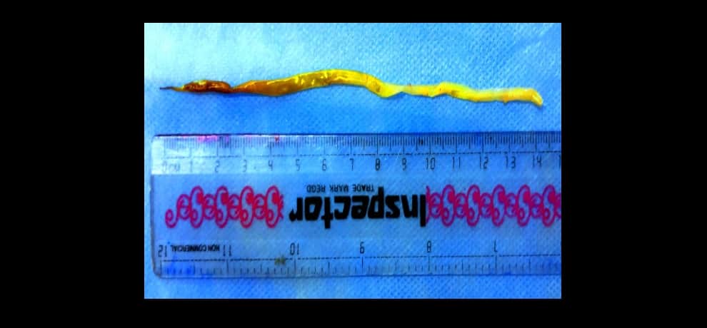doctors of gb pant hospital operated a child lever having 6 inch worm by indoscpe Technic 