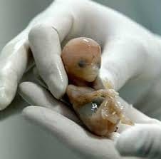 Neonatal death due to midwifery, pregnant condition critical
