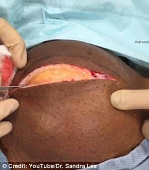  man's neck having lump the size of a bowling ball