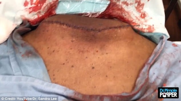  man's neck having lump the size of a bowling ball