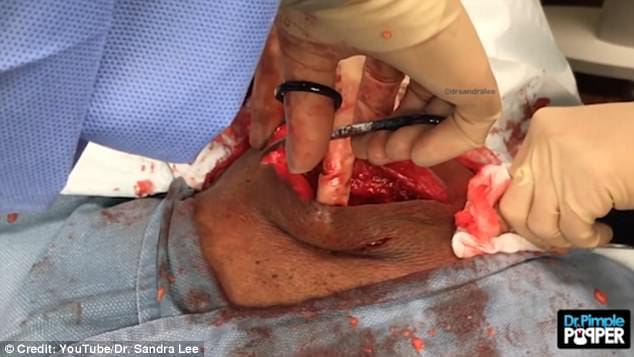  man's neck having lump the size of a bowling ball