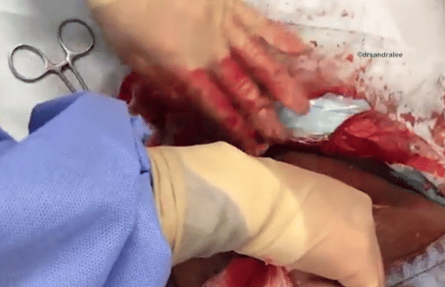  man's neck having lump the size of a bowling ball