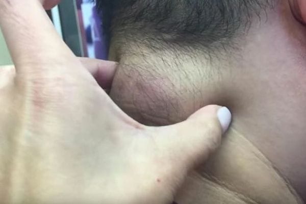  man's neck having lump the size of a bowling ball