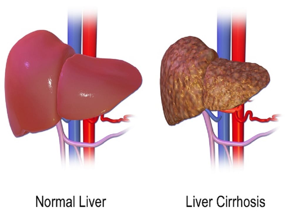 world liver day, Symptoms of liver disease, fatty liver disease