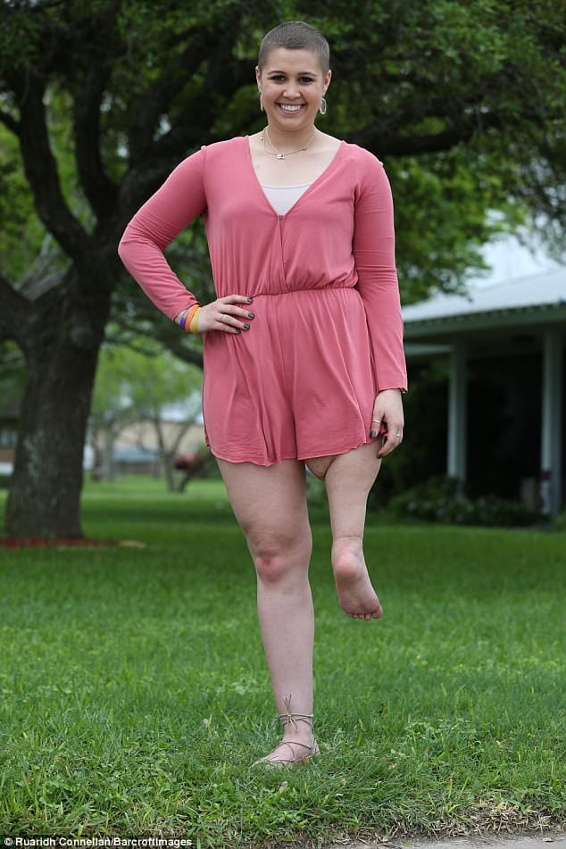Miss Teen usa knee replaced with her own ANKLE