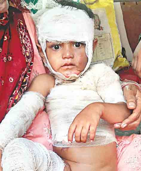 masum injured from hot tea