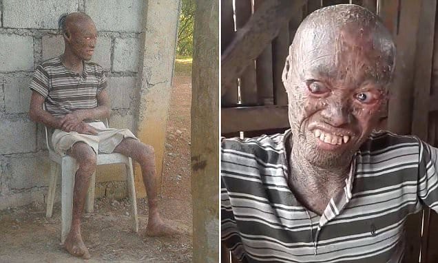filipino man with a rare skin disease looks like ghost