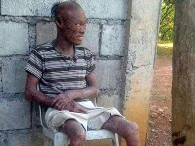 filipino man with a rare skin disease looks like ghost