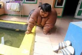 10 year old indonesian boy Arya Somantri, weight hit 30 STONE