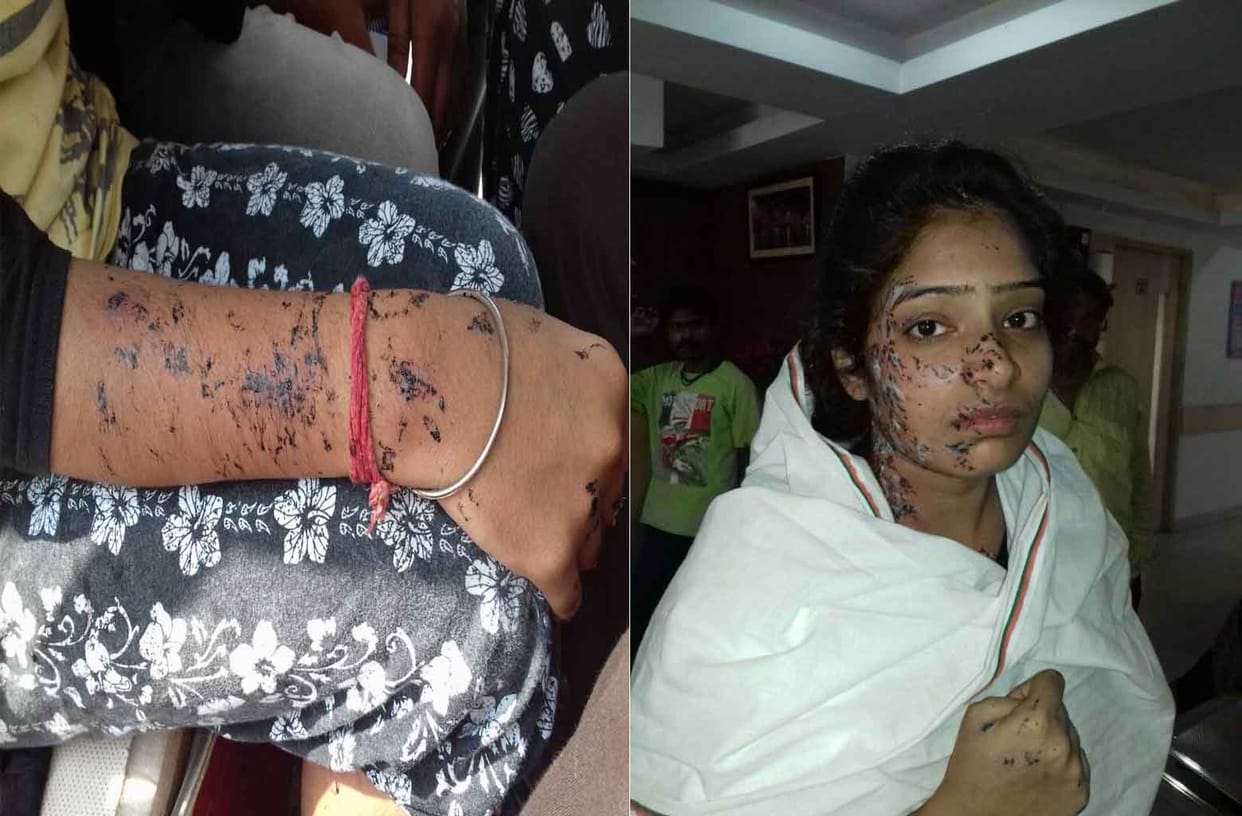 two sisters injured in varanasi at the time of road construction
