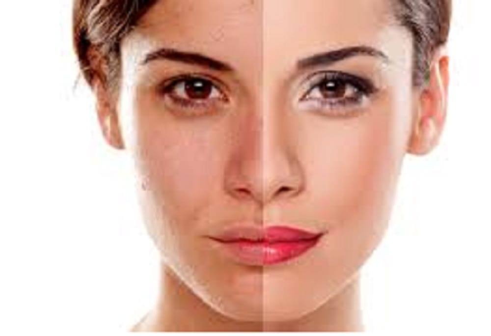 effective home remedies for get rid of sunburn