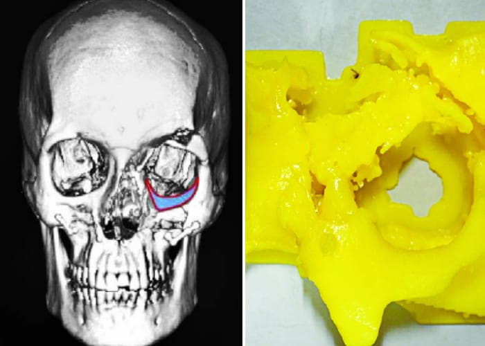 broken bone surgery by 3d in kgmu 