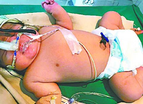 Diabetes mellitus 5.680 kg baby