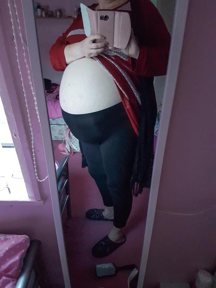 mums of four having giant stone in ovary