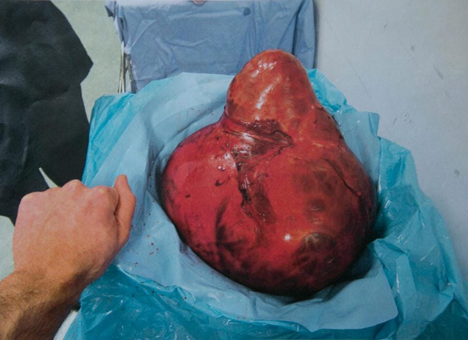 mums of four having giant stone in ovary