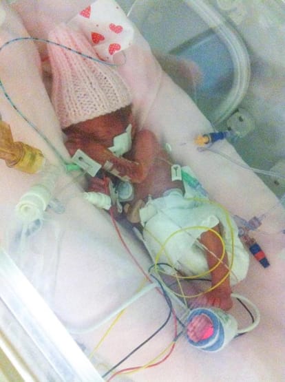 “miracle twins” born after the abortion limit 