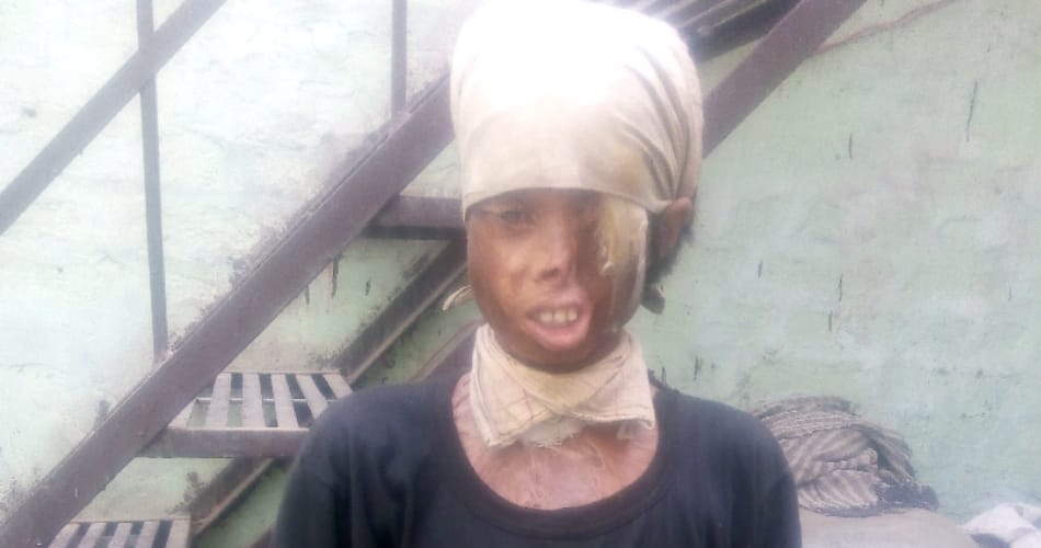 kaithal acid attack victim vijay story