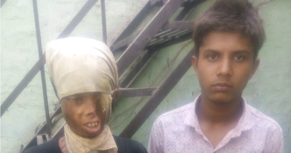 kaithal acid attack victim vijay story