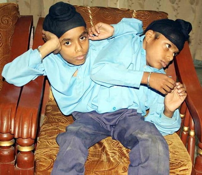 miracle of god, Conjoined twins Sohna Mohna at Pingalwara punjab