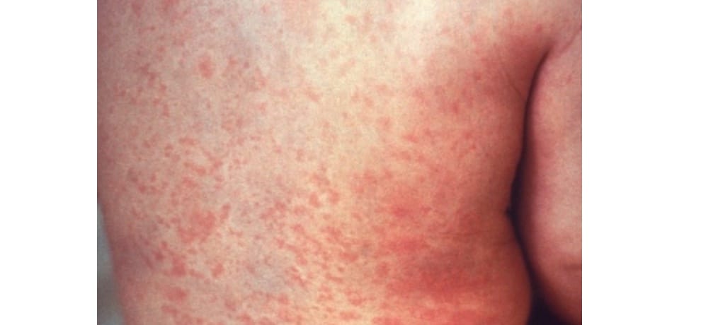 rubella to children in mandi