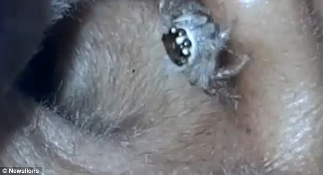 spider crawls out of woman’s EAR 