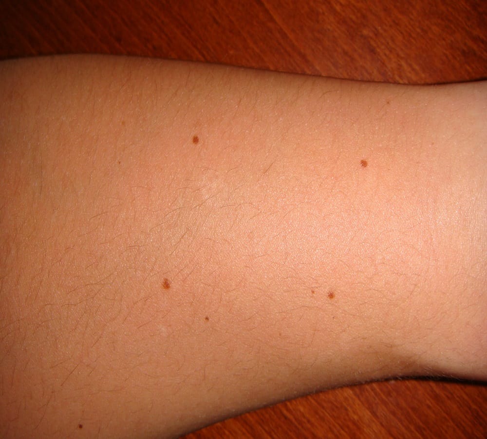 mole on your body tell about travel and rest