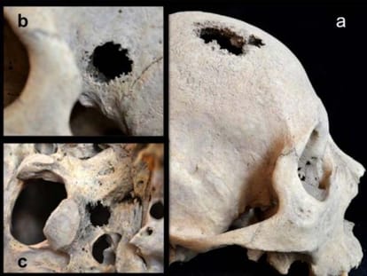 Archaeologists Found a Medieval Body With a Tumor