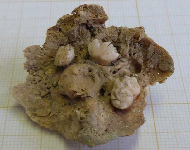 Archaeologists Found a Medieval Body With a Tumor