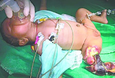 The baby's leg was damaged in the treatment round