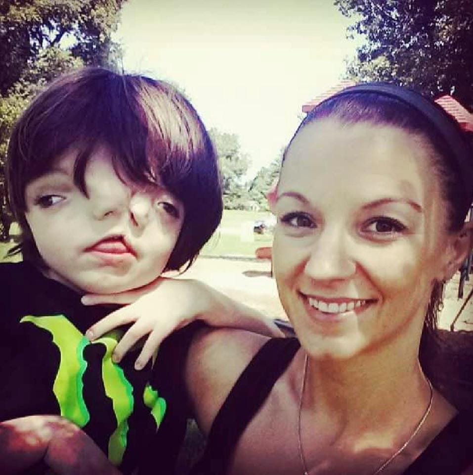 boy born with faces celebrates his 13 birthday