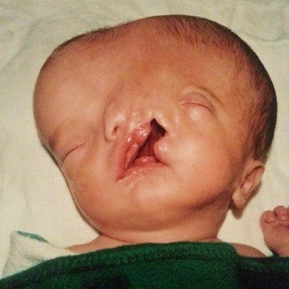 boy born with faces celebrates his 13 birthday