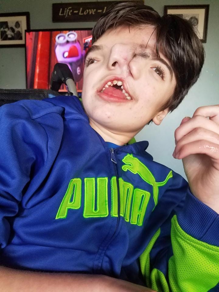 boy born with faces celebrates his 13 birthday