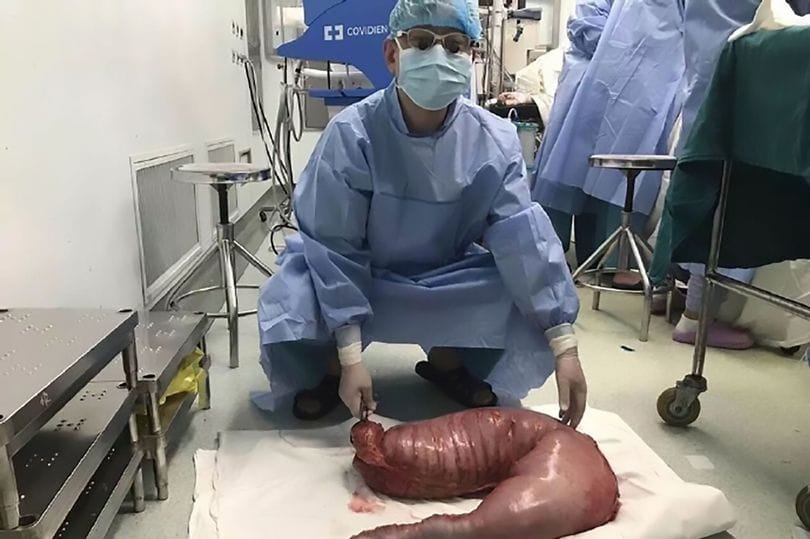 doctors remove 30 inches of china man’s bowel 